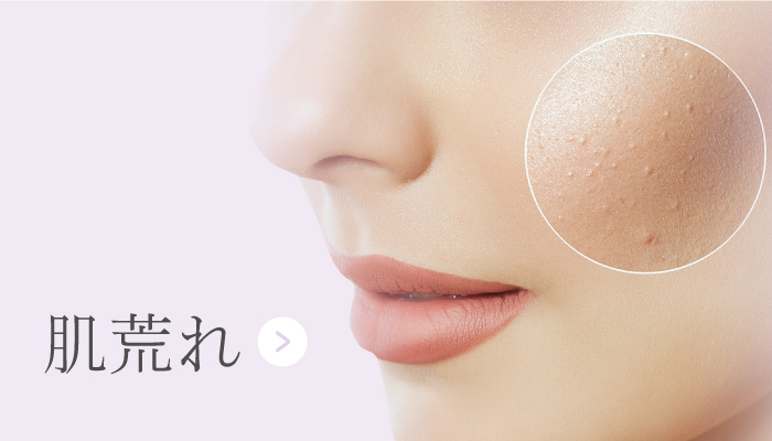 肌荒れ
